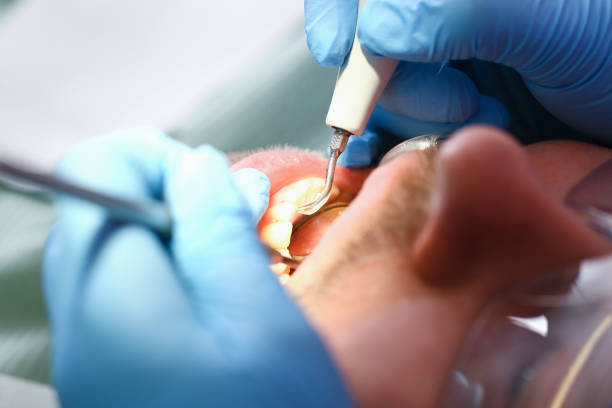 Best Emergency Treatment for Dental Infections or Abscesses in Divernon, IL
