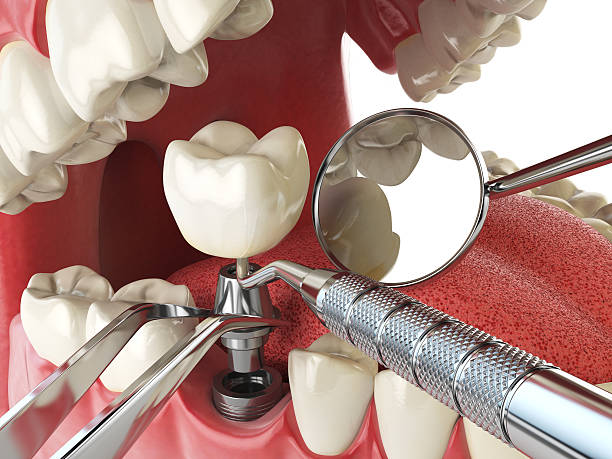 Best Emergency Root Canal Treatment in Divernon, IL